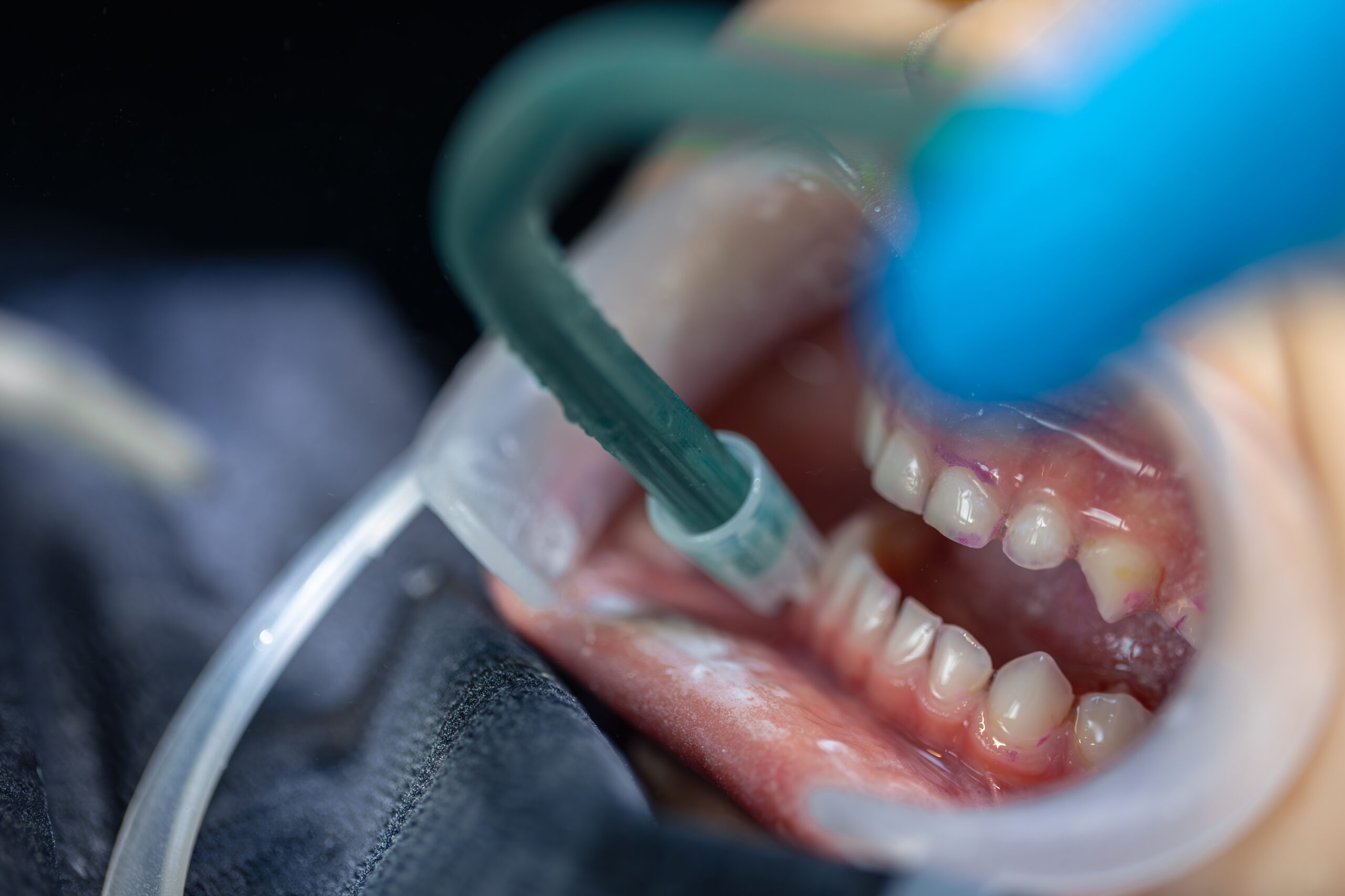 Close-up of a child’s mouth during dental treatment. Dentistry. Dental treatment.