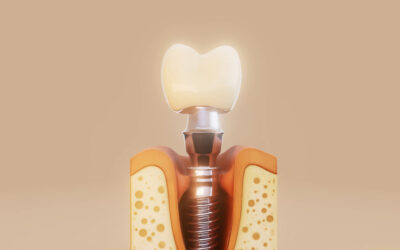 Despre implantul dentar